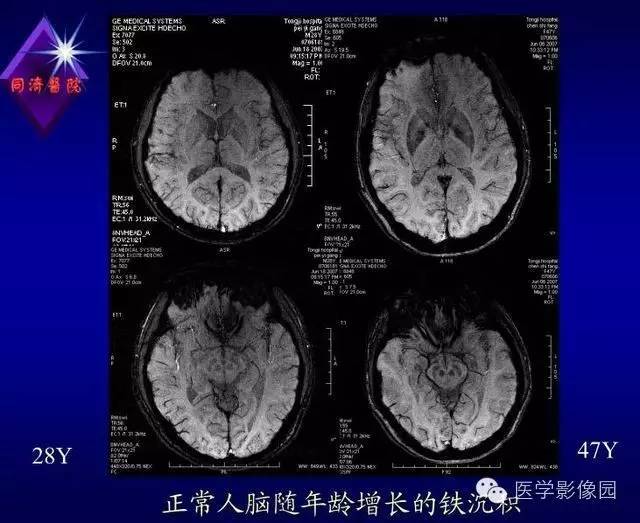 【PPT】MR磁敏感成像SWI原理及其在脑部的应用