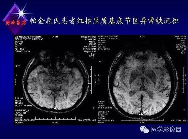 【PPT】MR磁敏感成像SWI原理及其在脑部的应用