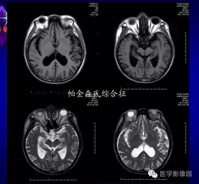 【PPT】MR磁敏感成像SWI原理及其在脑部的应用