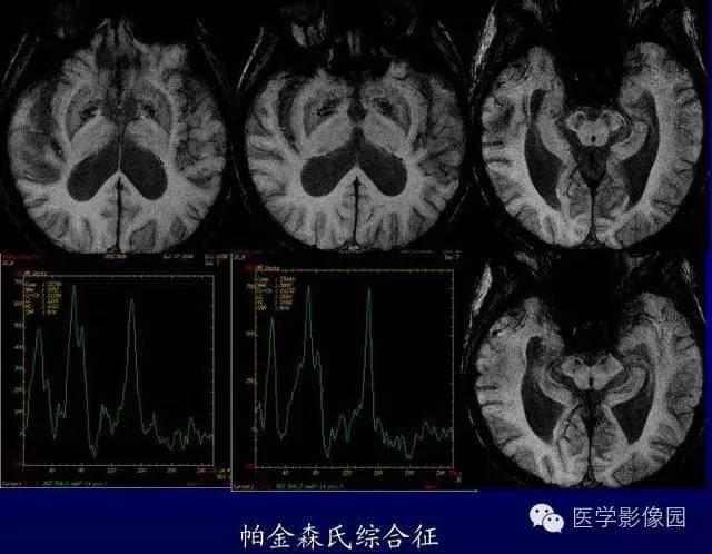【PPT】MR磁敏感成像SWI原理及其在脑部的应用