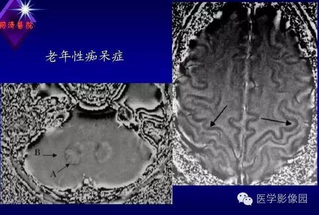 【PPT】MR磁敏感成像SWI原理及其在脑部的应用