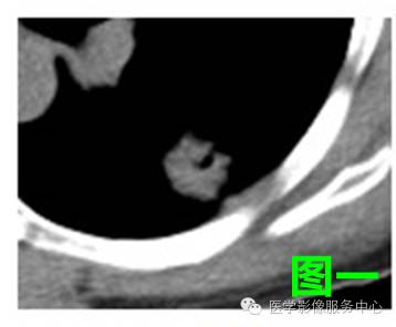 六个肺结节分别对应的影像征象，你能答对几个？