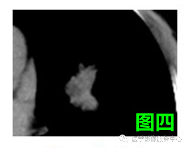 六个肺结节分别对应的影像征象,你能答对几个? 六个肺结节分别对应的影像征象,你能答对几个?