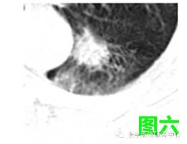 六个肺结节分别对应的影像征象,你能答对几个? 六个肺结节分别对应的影像征象,你能答对几个?