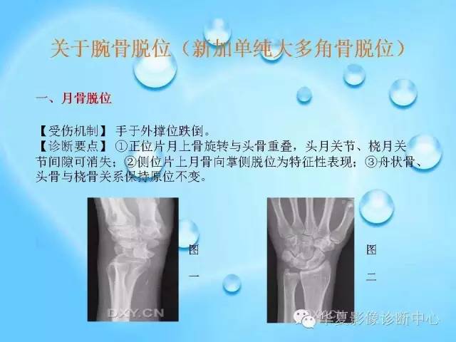 【PPT】关于腕骨脱位