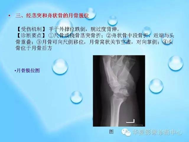 【PPT】关于腕骨脱位