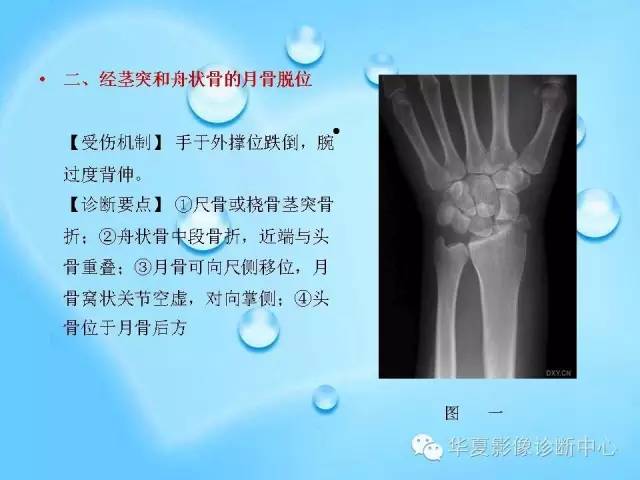 【PPT】关于腕骨脱位