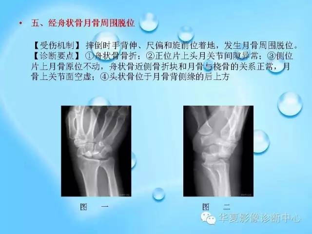 【PPT】关于腕骨脱位