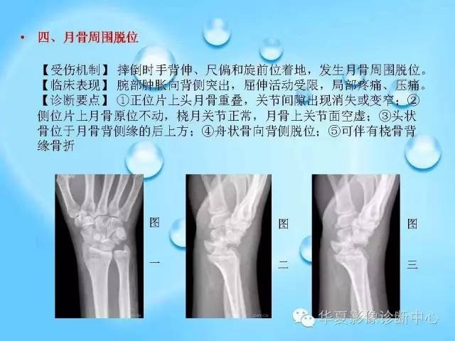 【PPT】关于腕骨脱位