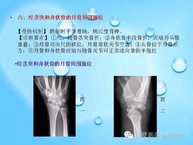 【PPT】关于腕骨脱位