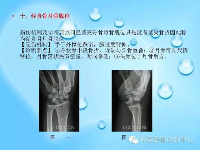 【PPT】关于腕骨脱位