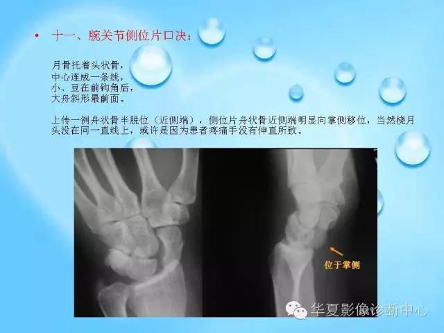 【PPT】关于腕骨脱位