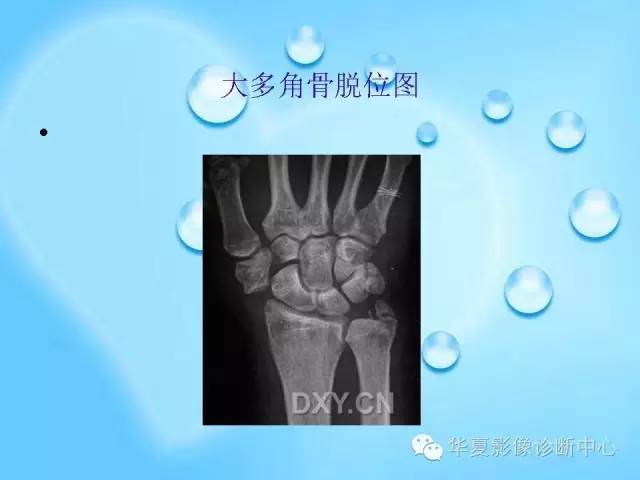 【PPT】关于腕骨脱位