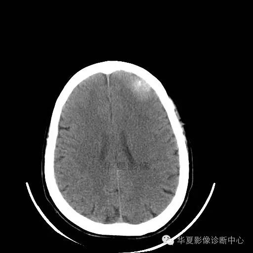 【病例】这个急诊CT，你会误诊吗？