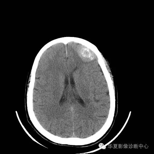 【病例】这个急诊CT，你会误诊吗？