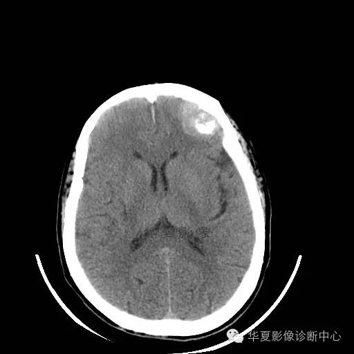 【病例】这个急诊CT，你会误诊吗？