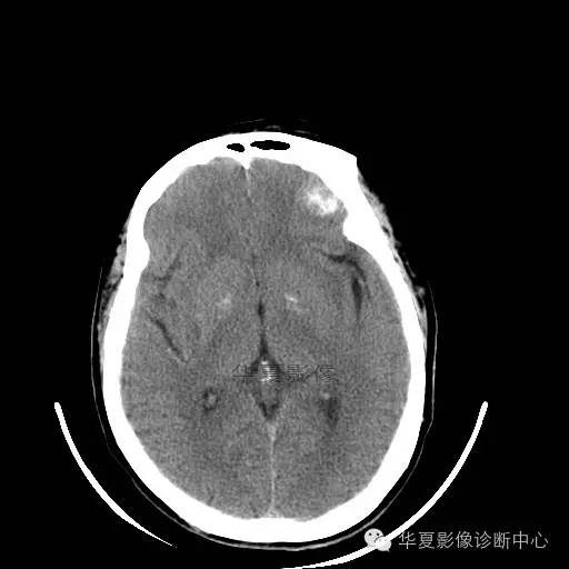 【病例】这个急诊CT，你会误诊吗？