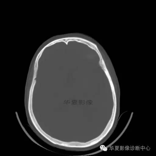 【病例】这个急诊CT，你会误诊吗？