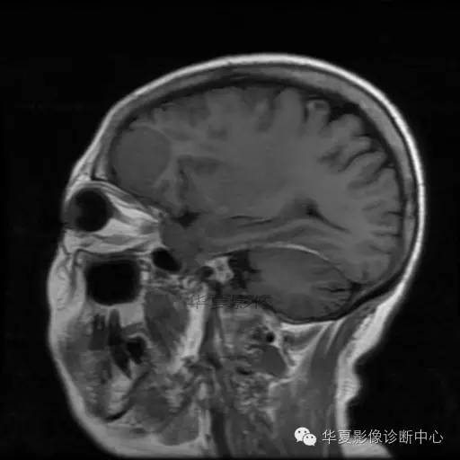 【病例】这个急诊CT，你会误诊吗？