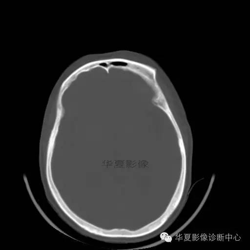 【病例】这个急诊CT，你会误诊吗？