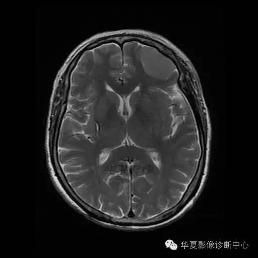 【病例】这个急诊CT，你会误诊吗？