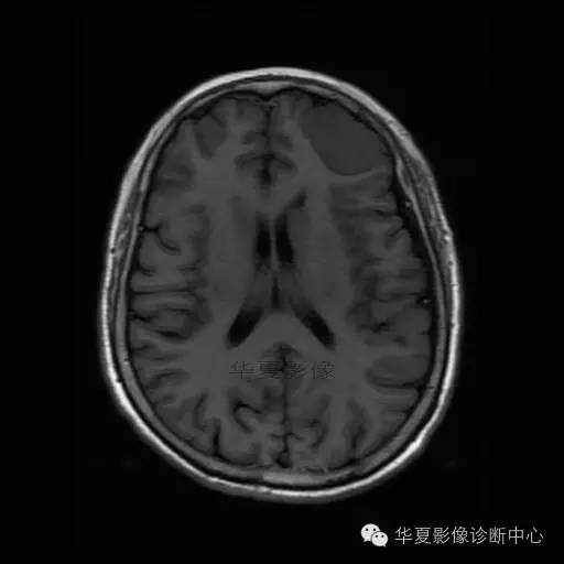 【病例】这个急诊CT，你会误诊吗？