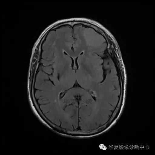 【病例】这个急诊CT，你会误诊吗？