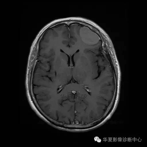 【病例】这个急诊CT，你会误诊吗？