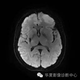 【病例】这个急诊CT，你会误诊吗？