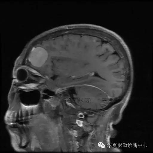 【病例】这个急诊CT，你会误诊吗？