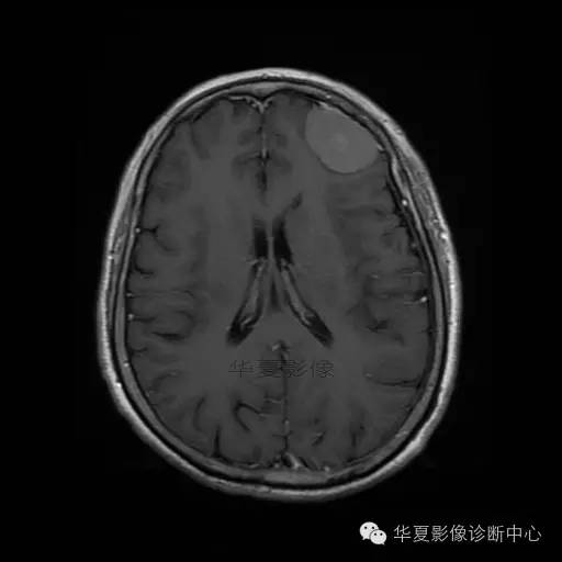 【病例】这个急诊CT，你会误诊吗？