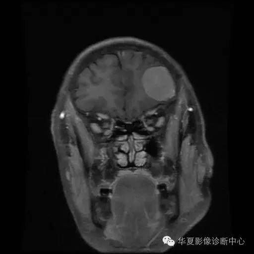 【病例】这个急诊CT，你会误诊吗？