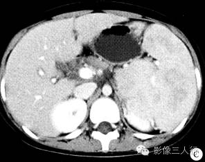 【病例】嗜血细胞综合征1例CT影像表现