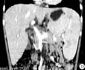 【病例】嗜血细胞综合征1例CT影像表现