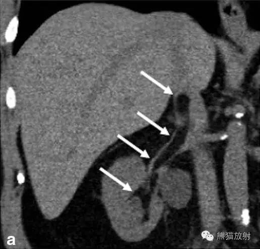 【双语病例】肾静脉血管内脂肪瘤1例