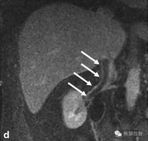 【双语病例】肾静脉血管内脂肪瘤1例 【双语病例】肾静脉血管内脂肪瘤1例