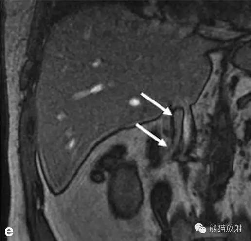 【双语病例】肾静脉血管内脂肪瘤1例 【双语病例】肾静脉血管内脂肪瘤1例