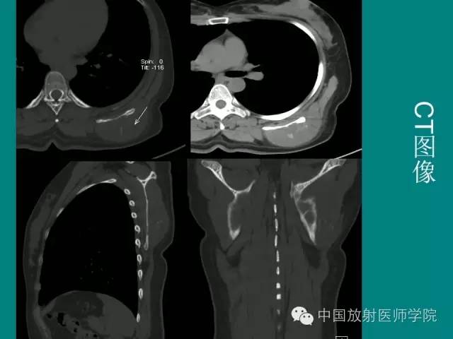 【病例】左肩部尤文氏肉瘤1例CT及MR影像表现