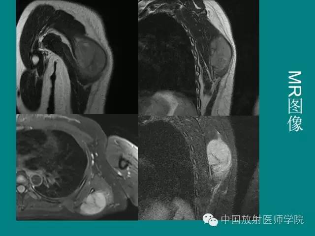 【病例】左肩部尤文氏肉瘤1例CT及MR影像表现