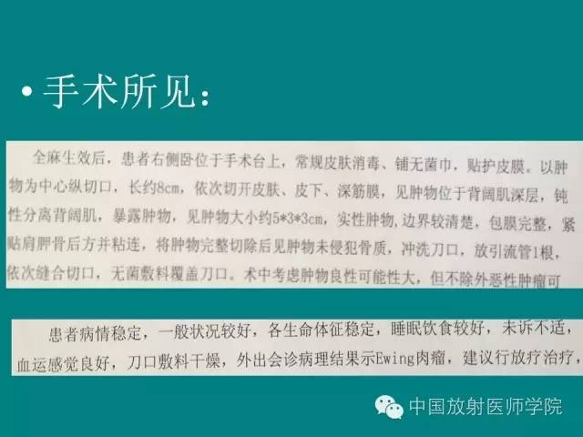 【病例】左肩部尤文氏肉瘤1例CT及MR影像表现