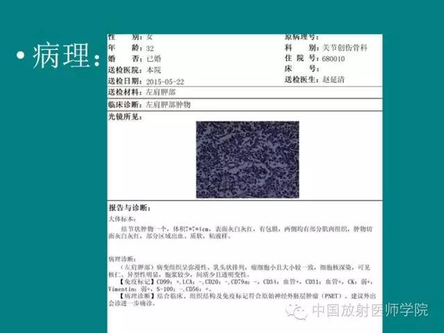 【病例】左肩部尤文氏肉瘤1例CT及MR影像表现