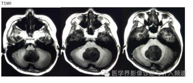 【病例】髓母细胞瘤1例MR影像表现