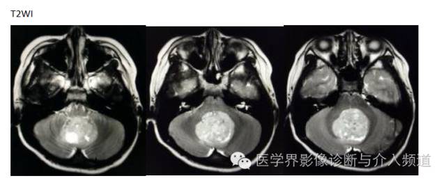 【病例】髓母细胞瘤1例MR影像表现