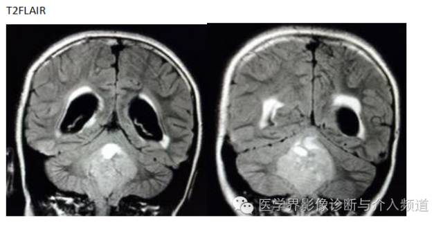 【病例】髓母细胞瘤1例MR影像表现