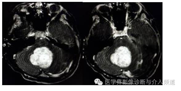 【病例】髓母细胞瘤1例MR影像表现