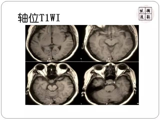 【病例】垂体转移瘤1例MR影像表现