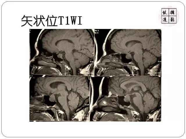 【病例】垂体转移瘤1例MR影像表现