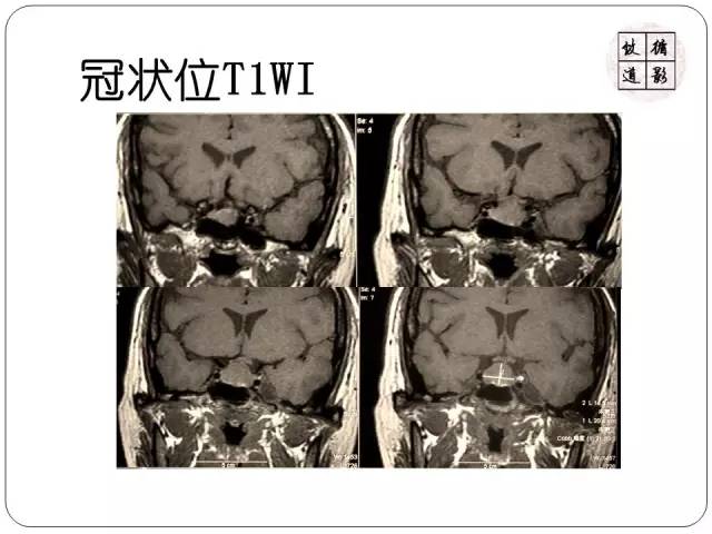 【病例】垂体转移瘤1例MR影像表现
