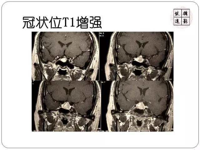 【病例】垂体转移瘤1例MR影像表现