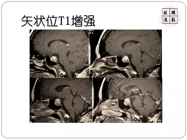【病例】垂体转移瘤1例MR影像表现